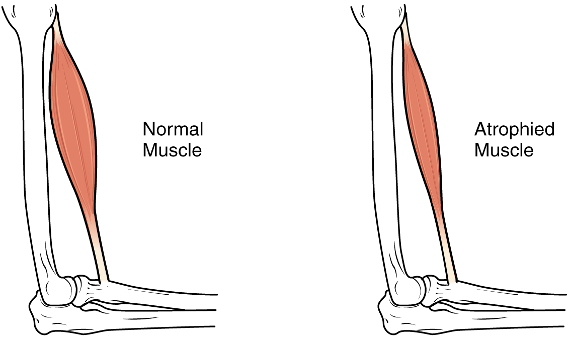 Diagram of arm skeletal muscle undergoing neurogenic or disuse atrophy