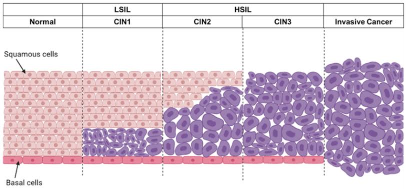 Squamous Intraepithelial Lesion of the Cervix spectrum