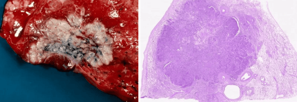 Squamous cell carcinoma Gross and Microscopic
