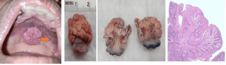 Squamous cell papillomas