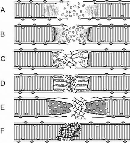 Stepwise illustration of myofiber rupture, contraction band formation, myotube fusion, and scar remodeling