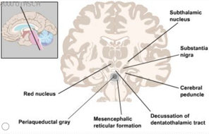 Coronal brain section of the subthalamus and adjacent midbrain