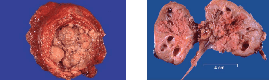 Transitional cell carcinoma (Urothelial carcinoma) Gross Pathology