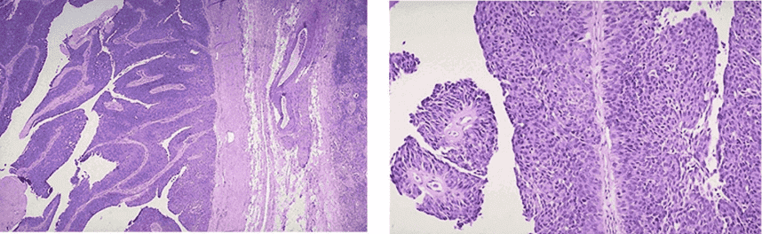 Urothelial carcinoma Histopathology