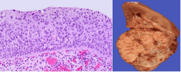Urothelial carcinoma in situ and Renal Cell Carcinoma