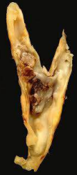 Atherosclerotic plaque and vascular lumen thrombosis