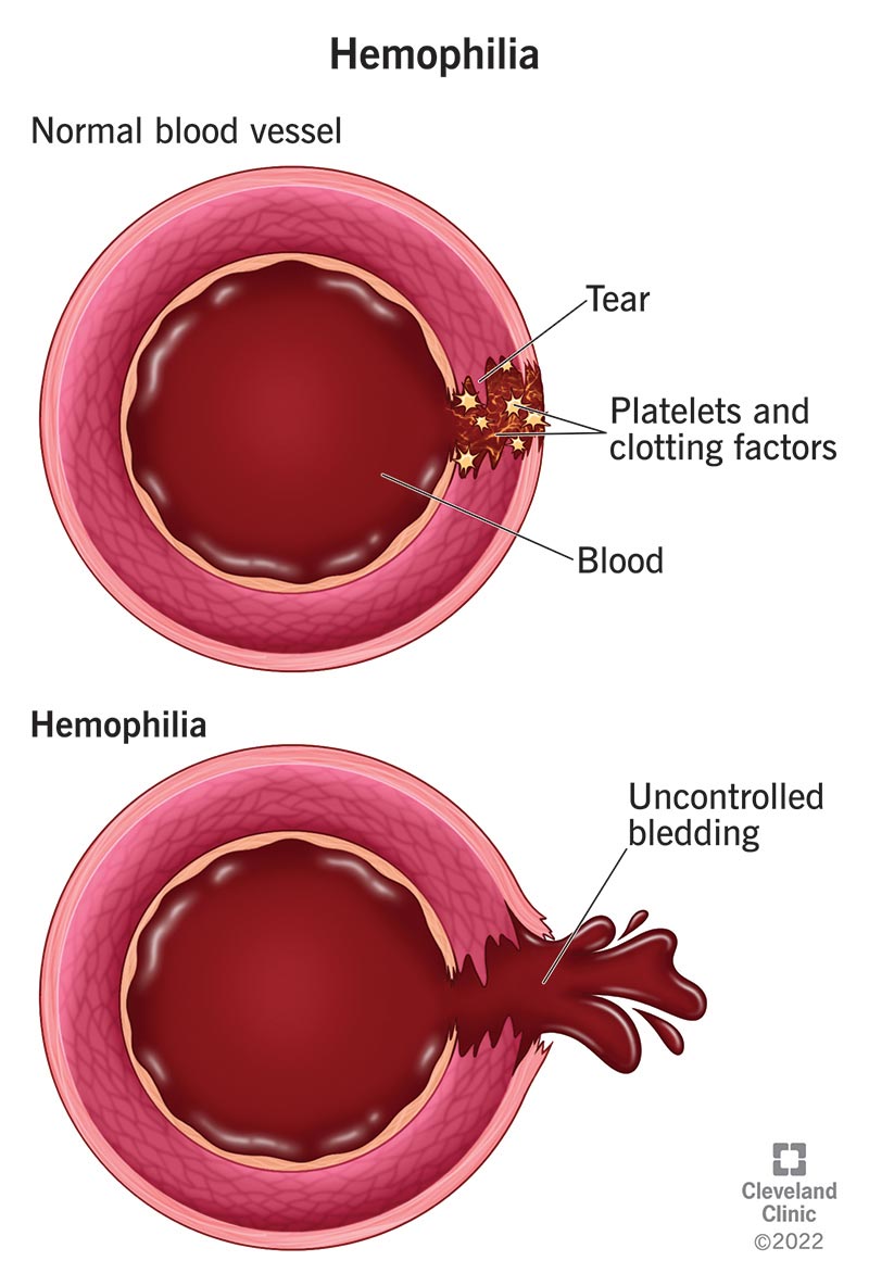 Vascular Hemostasis Defect in Hemophilia