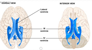 Ventricular casts demonstrating third ventricle recesses