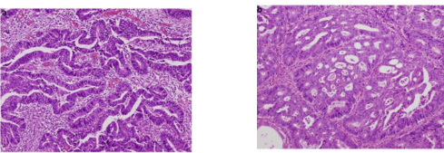 Well and Moderately Differentiated Adenocarcinoma