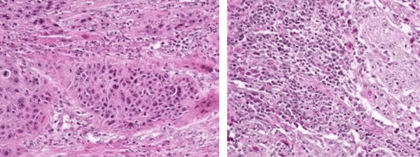 Moderately and poorly differentiated squamous cell carcinoma