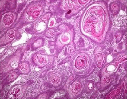 Well differentiated squamous cell carcinoma with keratin pearls