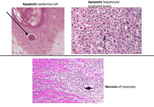 Microscopic histology of apoptotic cells: skin, liver, and myocardium
