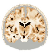 Coronal Brain Section Lateral Impact