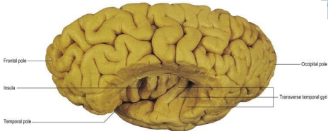 Dissection of lateral sulcus exposing insula and transverse temporal gyri