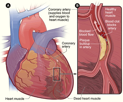 Atherosclerosis and coronary occlusion leading to myocardial infarction