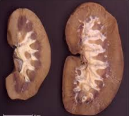 Gross renal compensatory hypertrophy following unilateral nephrectomy